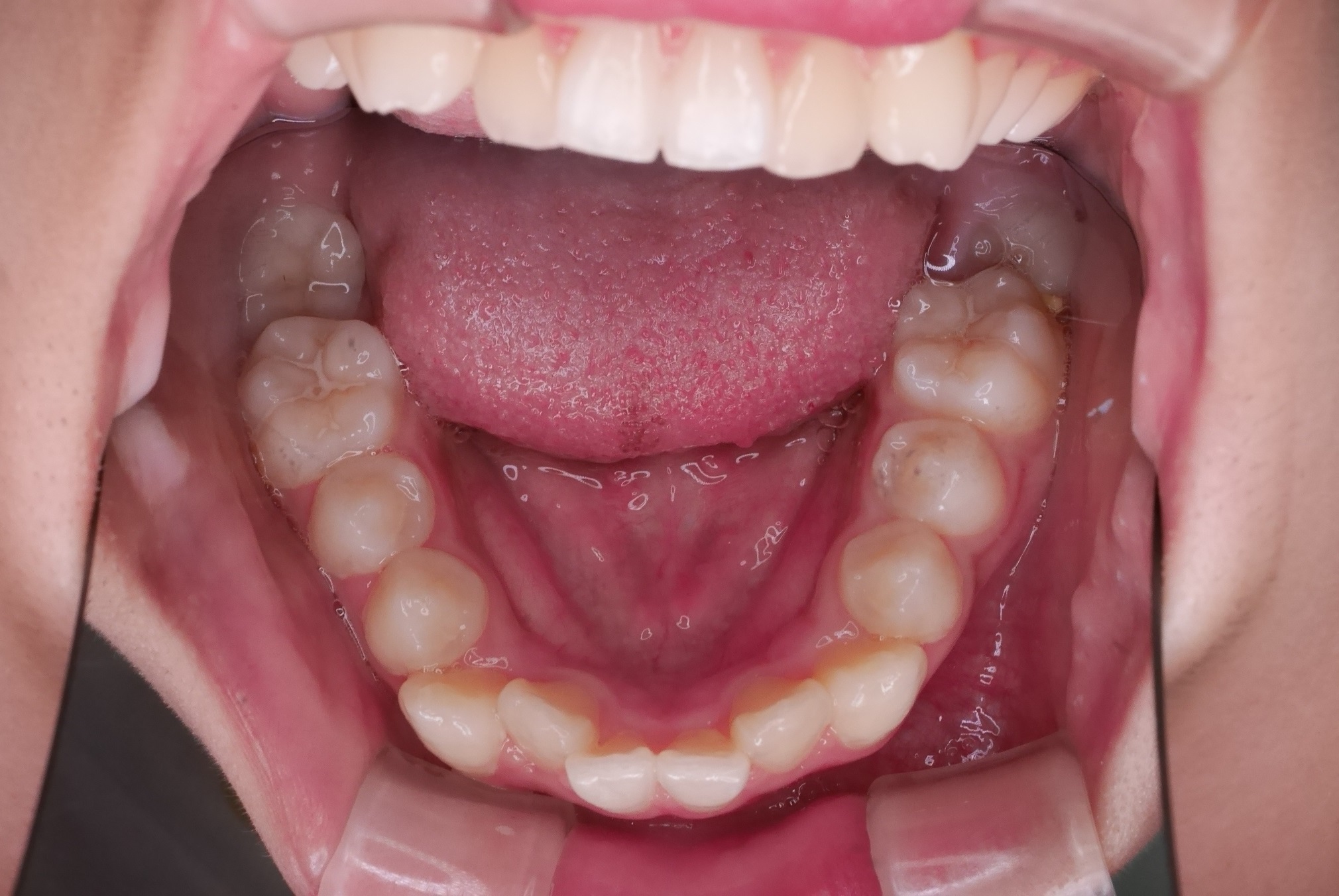 奥歯を整直した治療症例 治療前