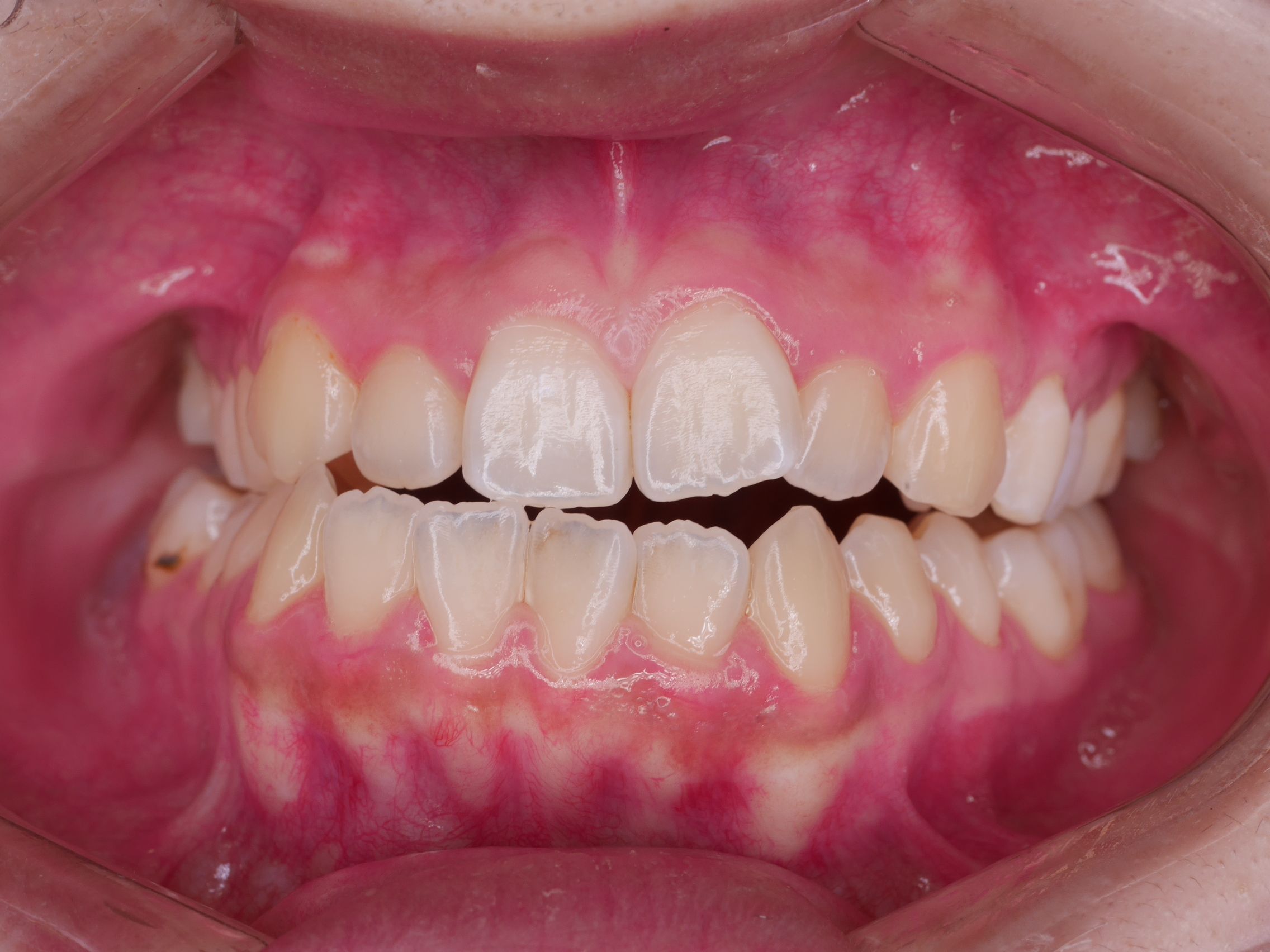 口腔外科処置を併用した治療症例（外科的矯正治療） 治療前