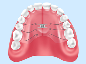 上顎拡大床（拡大装置：取り外し可能）