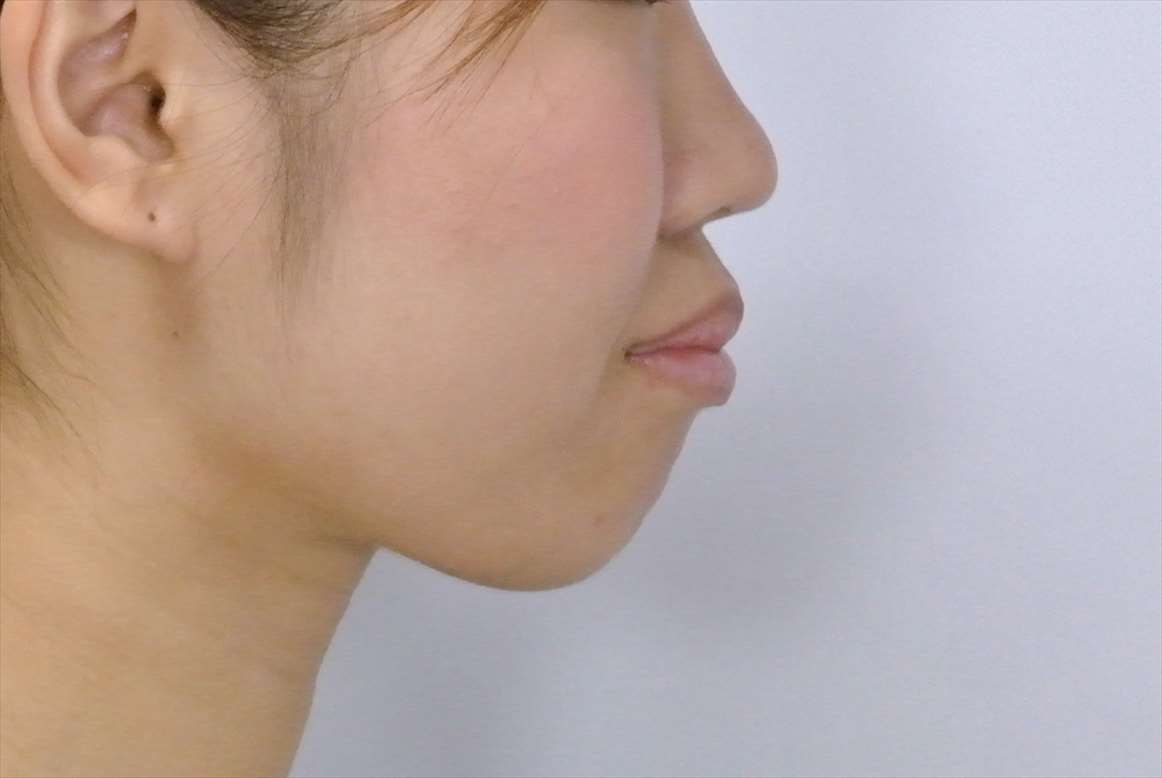 上下顎前突の治療症例 治療前