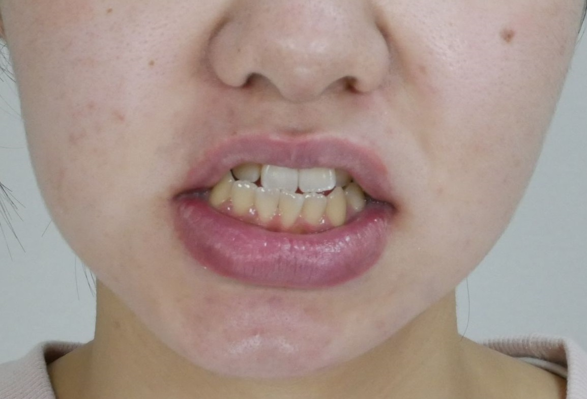 口腔外科処置を併用した治療症例（外科的矯正治療）