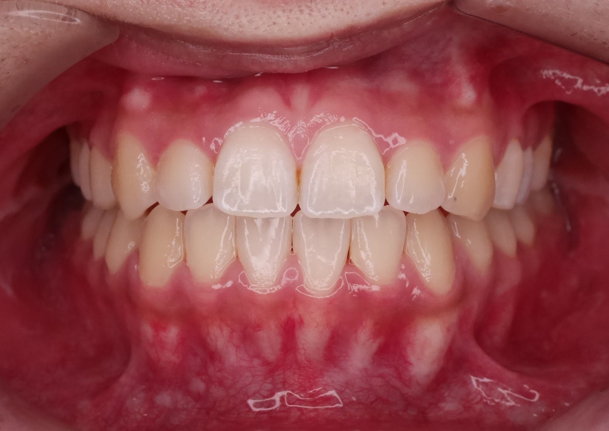 口腔外科処置を併用した治療症例（外科的矯正治療） 治療前