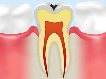 虫歯や歯周病にかかりやすくなります